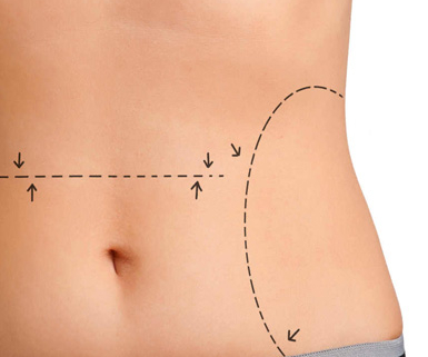 abdominoplastia alicante