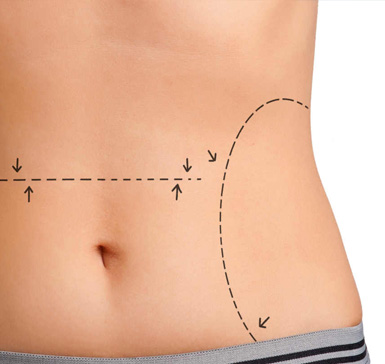 abdominoplastia alicante